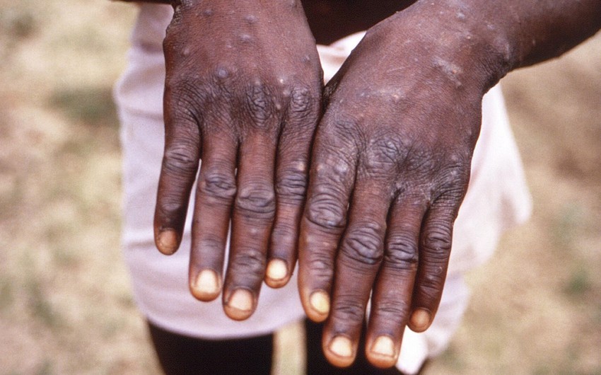 Nigeriyada meymunçiçəyi virusuna 39 yoluxma halı qeydə alınıb